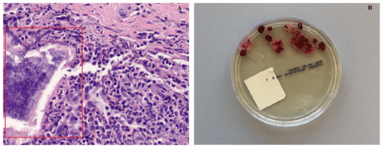 Figure 2. (A) Hematoxylin and eosin stain showing presence of sulfur granules as shown in red rectangular area. Magnification 200×. (B) Figure showing colony morphology in fungal culture with Sabouraud Dextrose agar.