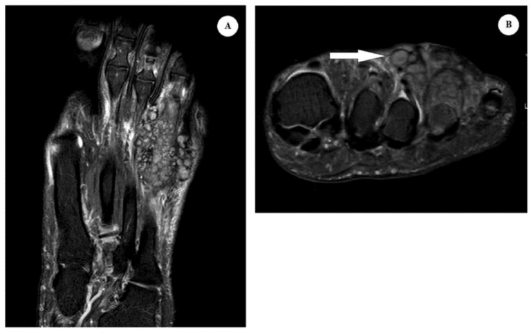 Figure 1. Magnetic resonance imaging (MRI) findings. (A) Coronal T2-weighted MRI image revealing an infiltrative multi-cystic mass along the dorsal aspect for the fourth metatarsophalangeal joint. (B) Axial view T2-weighted MRI image with ‘dot-in-a-circle’ sign as shown with the white arrow.
